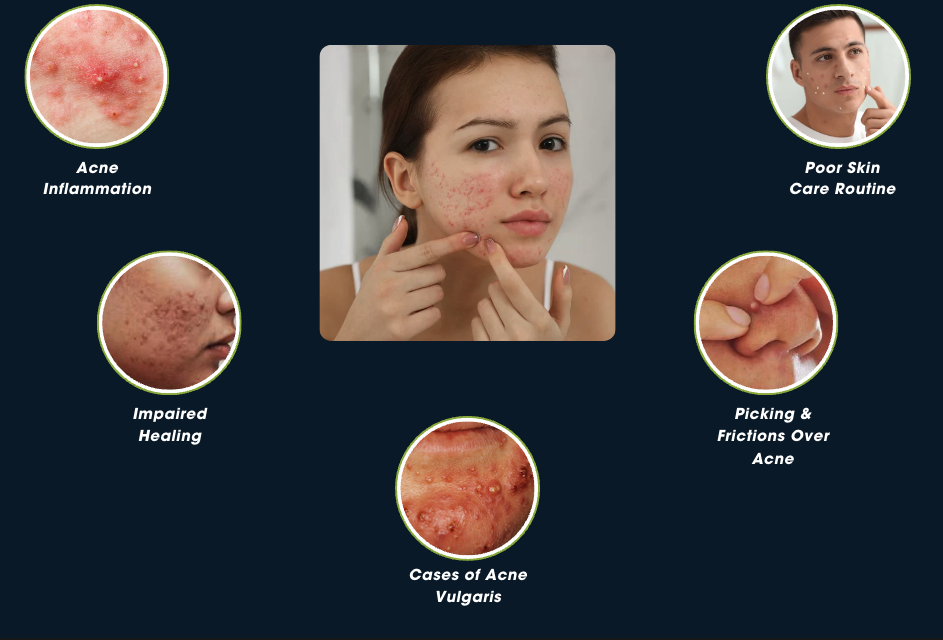 What Causes Acne Scar?